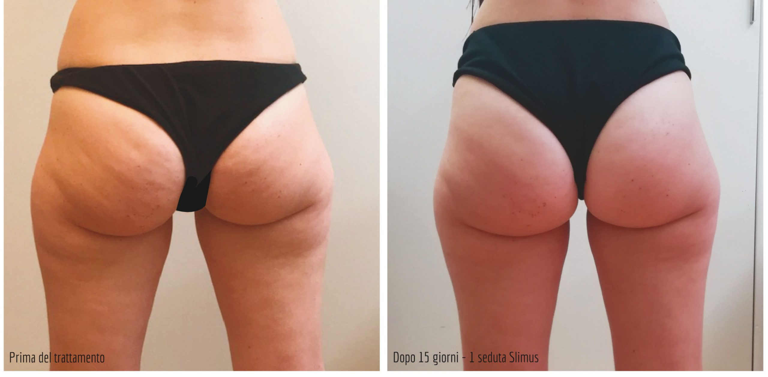 slimus-prima-dopo-glutei2-scaled.jpg