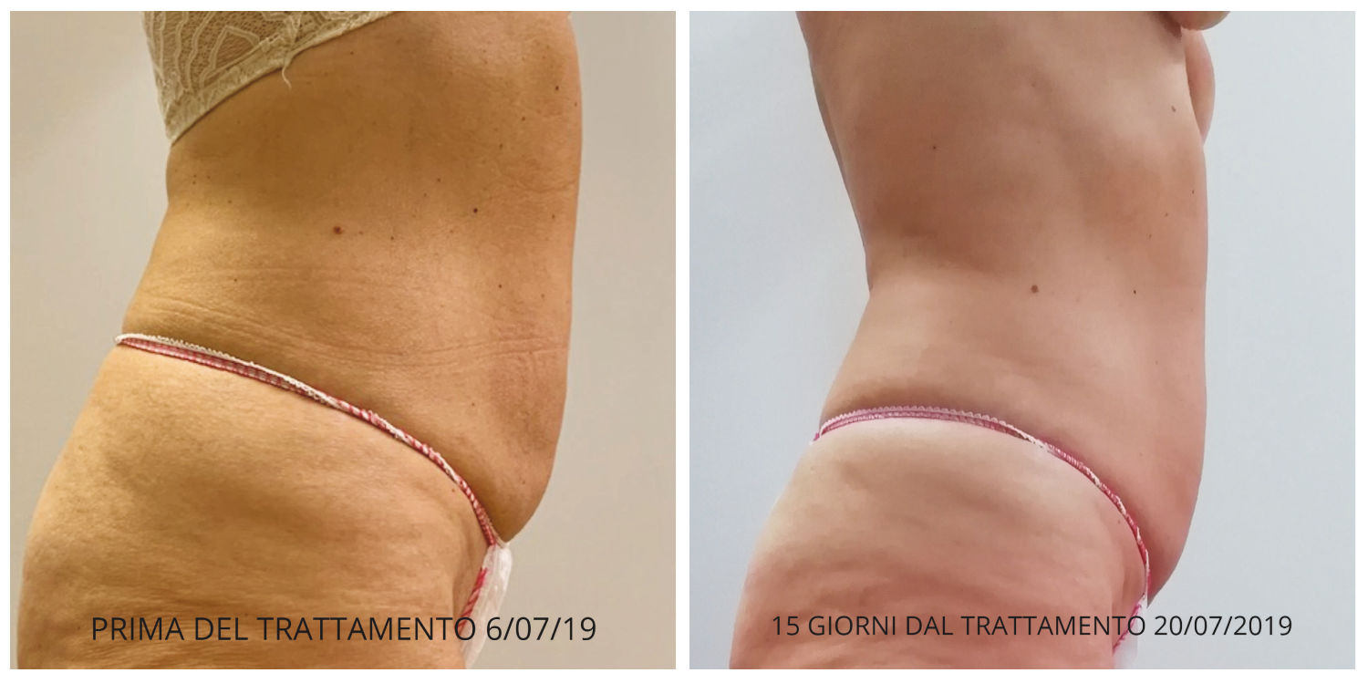 slimus-prima-dopo-rimodella.jpg